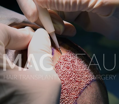 İğnesiz Anestezi ve Traşsız DHI Kalem Teknikli Saç Ekimi